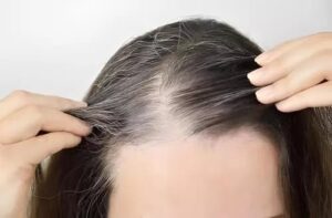 Queda de cabelo com canetas emagrecedoras: saiba o real motivo por trás